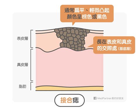 點痣禁忌|點痣筆一擦，黑痣就掉了？醫師冷笑科科兩聲：「點痣」沒你想得。